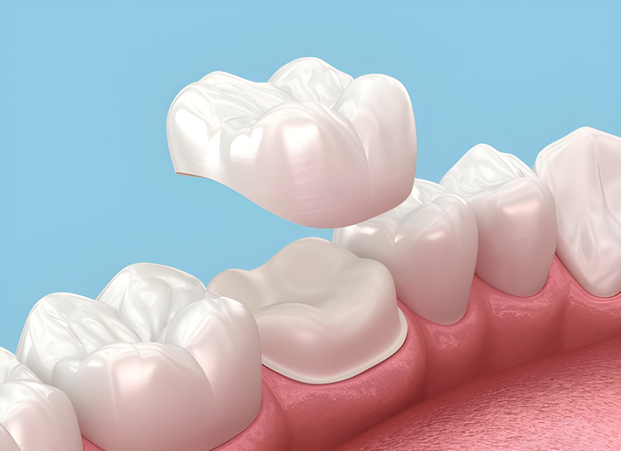 dental crowns in macleod
