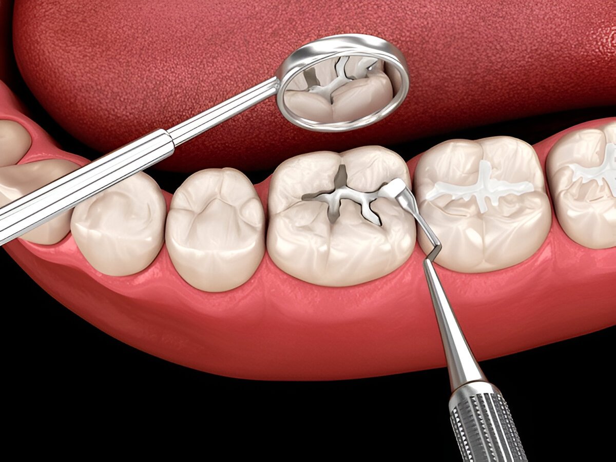 dental fillings near you