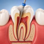 How root canal treatment saves your smile